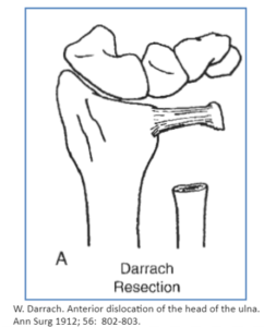 darrach resection