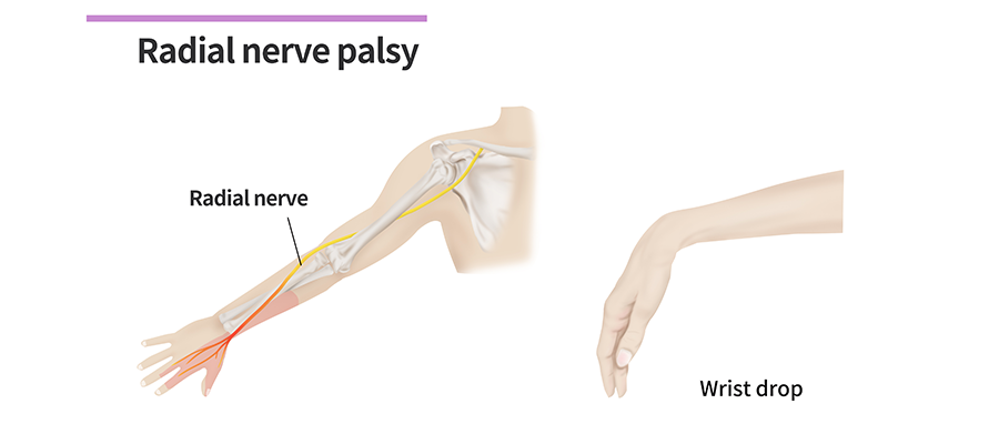 Radial Nerve Palsy PIN Palsy